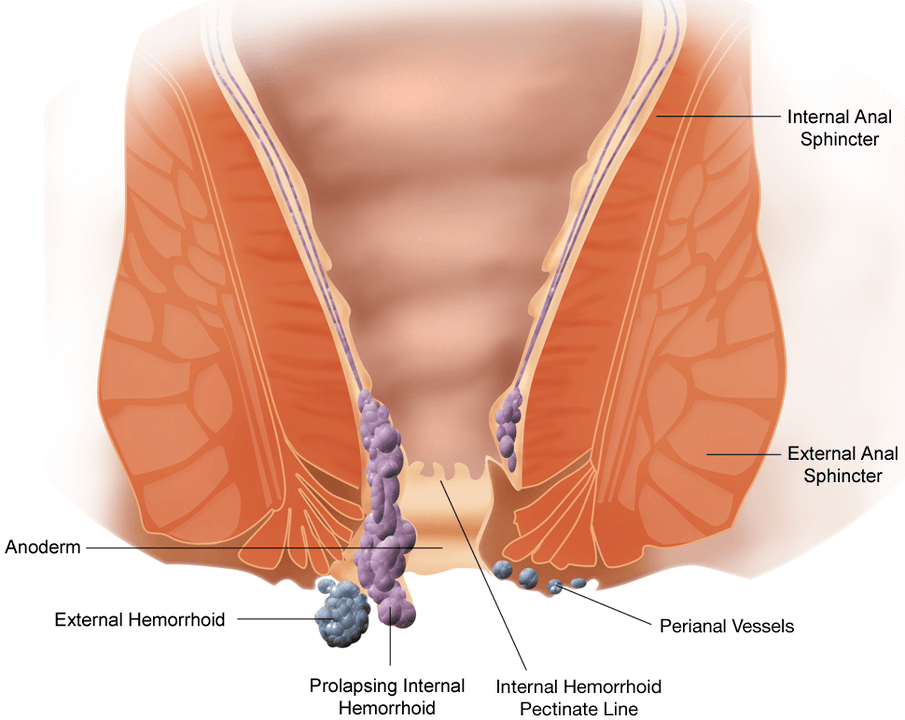 The development of hemorrhoids is accompanied by pain, itching and loss of nodes