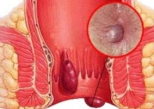 Like what hemorrhoids